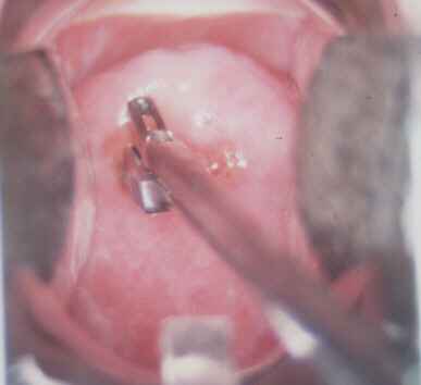 Biopsja szyjki macicy