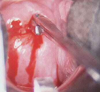 Biopsja szyjki macicy